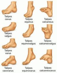 talipes是什么意思