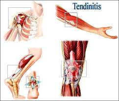 tendinitis是什么意思