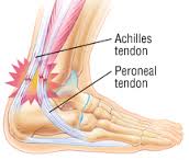 tendonitis是什么意思