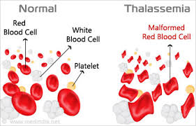 thalassemia是什么意思