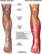 thrombophlebitis是什么意思