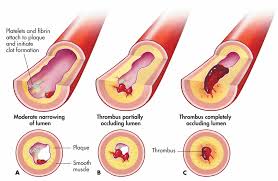 thrombus是什么意思
