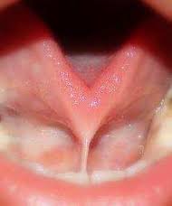tongue-tied是什么意思