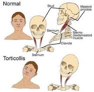 torticollis是什么意思