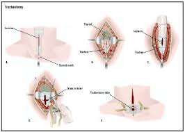 tracheotomy是什么意思