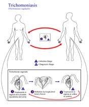 trichomoniasis是什么意思