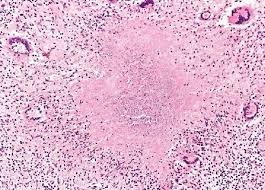 tuberculous是什么意思