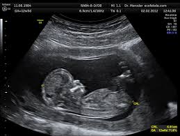 ultrasound是什么意思