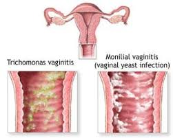 vaginitis是什么意思