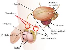 vasectomy是什么意思