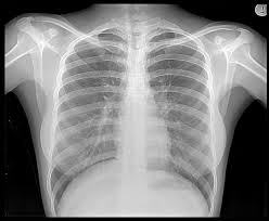 X-ray是什么意思
